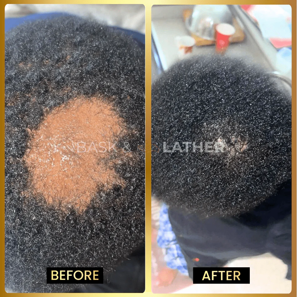 Scalp Stimulator- 3 Month Supply - Image 3