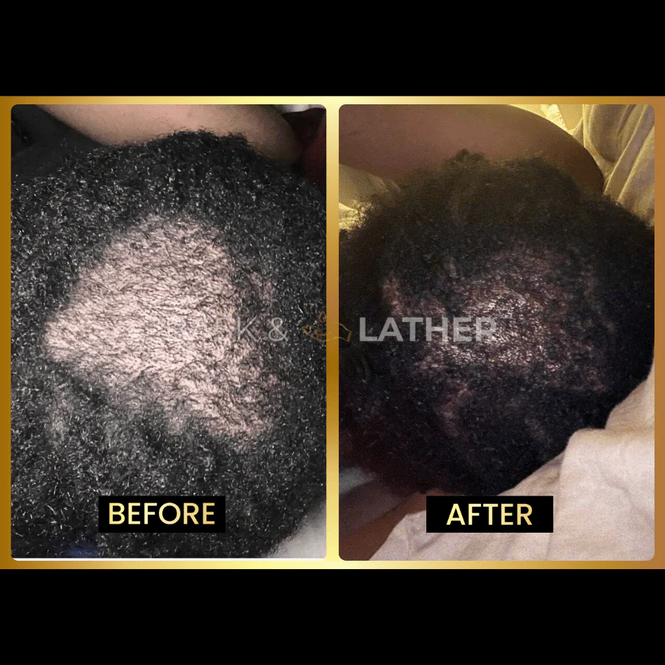 Scalp Stimulator- 3 Month Supply - Image 4