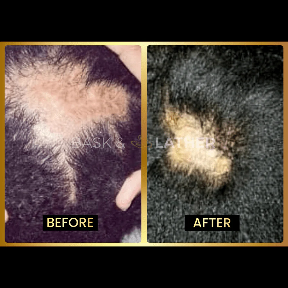 Scalp Stimulator- 3 Month Supply - Image 5