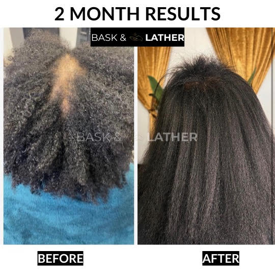 Healthy Hair Starter Kit- Limited Edition - Image 4